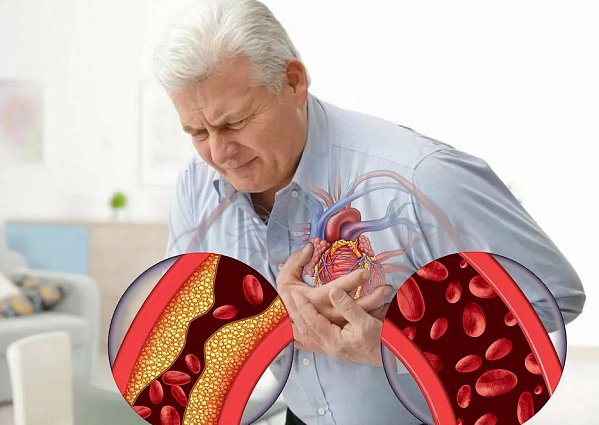 Ишемическая болезнь сердца: симптомы, лечение