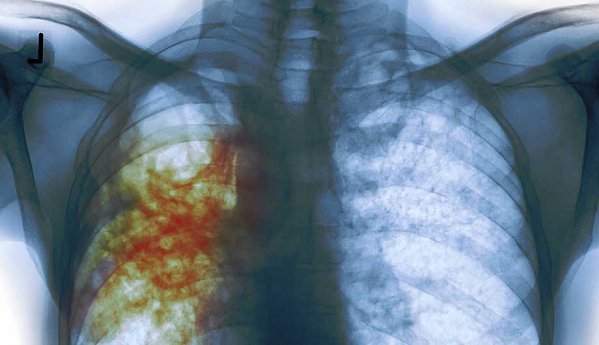 какое заболевание не относится к инфекционным грипп бронхиальная астма туберкулез